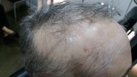 Los peligros del uso del pegamento en pelucas oncológicas